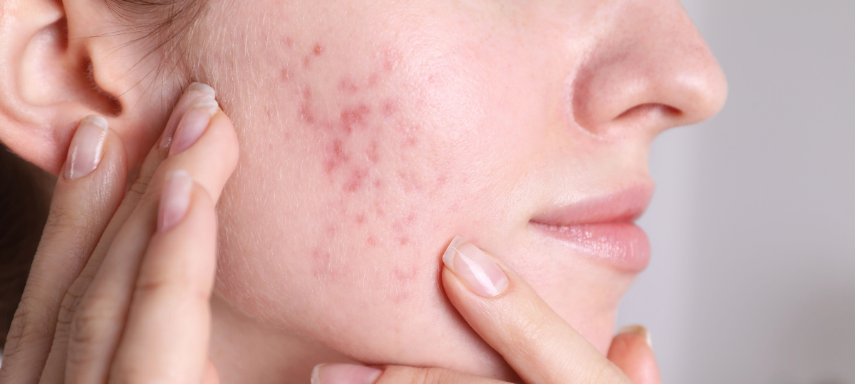 Hormonal Acne in Women: Causes, Triggers, and Natural Treatment Options